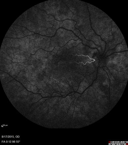 West Nile Virus Multifocal Choroiditis and diabetic retinopathy
Multifocal and clustered focal lesions are from west nile virus.  The retinopathy is probably diabetic but could also be related to west nile virus
