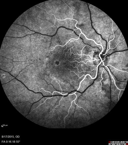 West Nile Virus Multifocal Choroiditis and diabetic retinopathy
Multifocal and clustered focal lesions are from west nile virus.  The retinopathy is probably diabetic but could also be related to west nile virus
