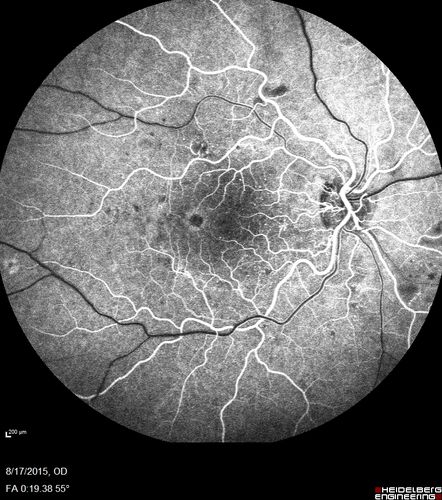 West Nile Virus Multifocal Choroiditis and diabetic retinopathy
Multifocal and clustered focal lesions are from west nile virus.  The retinopathy is probably diabetic but could also be related to west nile virus
