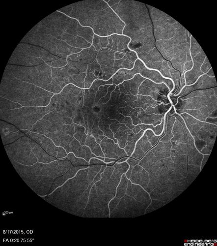 West Nile Virus Multifocal Choroiditis and diabetic retinopathy
Multifocal and clustered focal lesions are from west nile virus.  The retinopathy is probably diabetic but could also be related to west nile virus
