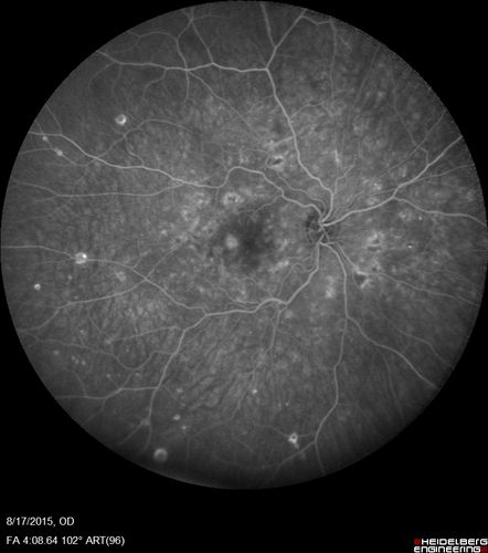 West Nile Virus Multifocal Choroiditis and diabetic retinopathy
Multifocal and clustered focal lesions are from west nile virus.  The retinopathy is probably diabetic but could also be related to west nile virus
