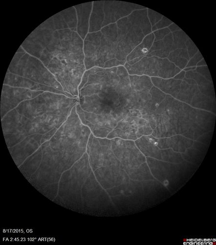 West Nile Virus Multifocal Choroiditis and diabetic retinopathy
Multifocal and clustered focal lesions are from west nile virus.  The retinopathy is probably diabetic but could also be related to west nile virus
