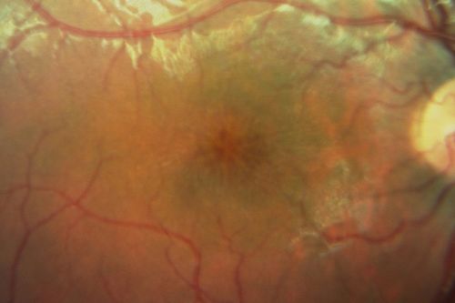X-linked Juvenille Retinoschisis - Peripheral Retinal Vascular Anomalies - Vitreous Hemorrhage - 8 Year Old Boy
8-year-old child  OD 20/40,  OS 20/50 
OD: Vertical C/D ratio is 0.2.  There are foveal cysts.  There is also a retinal elevation inferiorly and there are patchy peripheral retinal hemorrhages.  
OS: Vertical C/D ratio is 0.2.  There are foveal cysts.  There is peripheral retinal issues with some hemorrhage in some areas of peripheral retinoschisis.  

