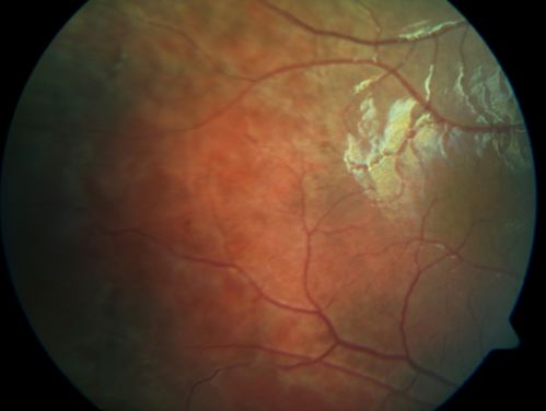 X-linked Juvenille Retinoschisis - Peripheral Retinal Vascular Anomalies - Vitreous Hemorrhage - 8 Year Old Boy
8-year-old child  OD 20/40,  OS 20/50 
OD: Vertical C/D ratio is 0.2.  There are foveal cysts.  There is also a retinal elevation inferiorly and there are patchy peripheral retinal hemorrhages.  
OS: Vertical C/D ratio is 0.2.  There are foveal cysts.  There is peripheral retinal issues with some hemorrhage in some areas of peripheral retinoschisis.  

