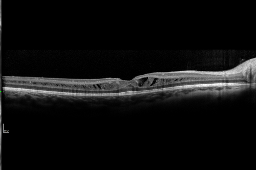 X-linked Juvenille Retinoschisis - Peripheral Retinal Vascular Anomalies - Vitreous Hemorrhage - 8 Year Old Boy
8-year-old child  OD 20/40,  OS 20/50 
OD: Vertical C/D ratio is 0.2.  There are foveal cysts.  There is also a retinal elevation inferiorly and there are patchy peripheral retinal hemorrhages.  
OS: Vertical C/D ratio is 0.2.  There are foveal cysts.  There is peripheral retinal issues with some hemorrhage in some areas of peripheral retinoschisis.  
