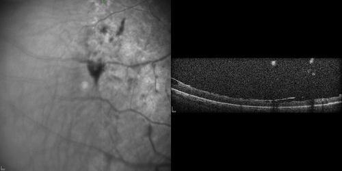 X-linked Juvenille Retinoschisis - Peripheral Retinal Vascular Anomalies - Vitreous Hemorrhage - 8 Year Old Boy
8-year-old child  OD 20/40,  OS 20/50 
OD: Vertical C/D ratio is 0.2.  There are foveal cysts.  There is also a retinal elevation inferiorly and there are patchy peripheral retinal hemorrhages.  
OS: Vertical C/D ratio is 0.2.  There are foveal cysts.  There is peripheral retinal issues with some hemorrhage in some areas of peripheral retinoschisis.  
