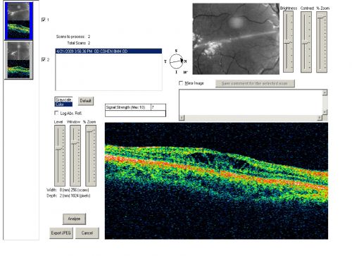 X-Linked Juvenille Retinoschisis 10 Year Old Child treated with Trusopt
10-year-old child has x-linked juvenile retinoschisis  VA 20/60, OS is 20/100.  Macula and Vision improved with Trusopt drops.
Keywords: x-linked juvenille retinoschisis;x linked;macula schisis;cme