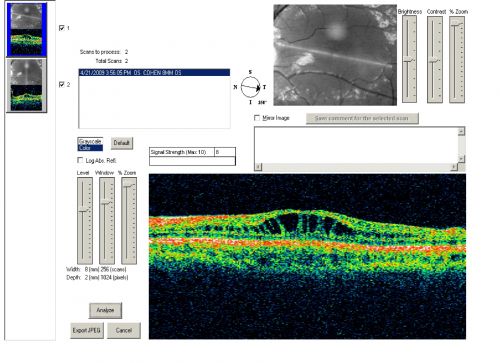 X-Linked Juvenille Retinoschisis 10 Year Old Child treated with Trusopt
10-year-old child has x-linked juvenile retinoschisis  VA 20/60, OS is 20/100.  Macula and Vision improved with Trusopt drops.
Keywords: x-linked juvenille retinoschisis;x linked;macula schisis;cme
