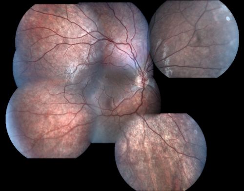 X-Linked Juvenille Retinoschisis 10 Year Old Child treated with Trusopt
10-year-old child has x-linked juvenile retinoschisis  VA 20/60, OS is 20/100.  Macula and Vision improved with Trusopt drops.
Keywords: x-linked juvenille retinoschisis;x linked;macula schisis;cme