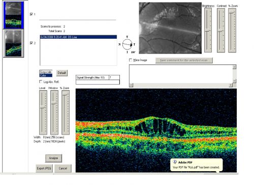 X-Linked Juvenille Retinoschisis 10 Year Old Child treated with Trusopt
10-year-old child has x-linked juvenile retinoschisis  VA 20/60, OS is 20/100.  Macula and Vision improved with Trusopt drops.
Keywords: x-linked juvenille retinoschisis;x linked;macula schisis;cme
