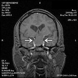 Optic Atrophy Left Eye and  Benign Pituitary Tumor - VA 20/20 Right Eye 20/160 Left Eye
58-year-old man has had gradually declining vision in the left eye over about the last 18 months.  Vision OD is 20/20, OS is 20/160
OCT SCAN:  The OCT scan of the nerve fiber layer in the right eye shows a thickness of 88 microns, the left eye 59 microns.
MRI did show a suprasellar mass which is affecting the optic chiasm and is responsible for the vision loss.  The tumor was resected and was a benign pituitary tumor. 
