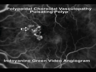 Polypoidal Choroidal Vasculopathy with Pulsating ICG polyp left eye
