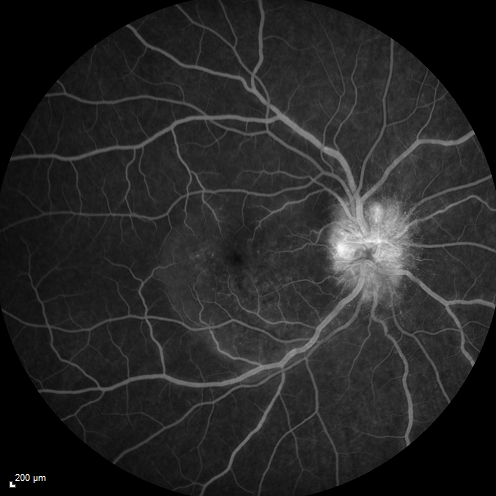 Syphillitic Optic Neuropathy and Maculopathy
46 year old woman with 2 weeks of vision loss OD.  VA 20/200 OD; 20/20 OS.  there are posterior vitreous cells on OCT in both eyes.  ICG, FAF, and FA show an abnormal macula OD.  VA improved to 20/30 within a month with treatment with PCN.
Keywords: syphillis