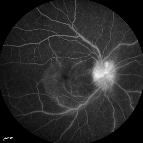 Syphillitic Optic Neuropathy and Maculopathy
46 year old woman with 2 weeks of vision loss OD.  VA 20/200 OD; 20/20 OS.  there are posterior vitreous cells on OCT in both eyes.  ICG, FAF, and FA show an abnormal macula OD.  VA improved to 20/30 within a month with treatment with PCN.
Keywords: syphillis