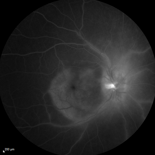 Syphillitic Optic Neuropathy and Maculopathy
46 year old woman with 2 weeks of vision loss OD.  VA 20/200 OD; 20/20 OS.  there are posterior vitreous cells on OCT in both eyes.  ICG, FAF, and FA show an abnormal macula OD.  VA improved to 20/30 within a month with treatment with PCN.
Keywords: syphillis