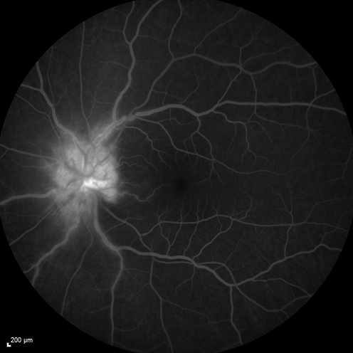 Syphillitic Optic Neuropathy and Maculopathy
46 year old woman with 2 weeks of vision loss OD.  VA 20/200 OD; 20/20 OS.  there are posterior vitreous cells on OCT in both eyes.  ICG, FAF, and FA show an abnormal macula OD.  VA improved to 20/30 within a month with treatment with PCN.
Palabras clave: syphillis