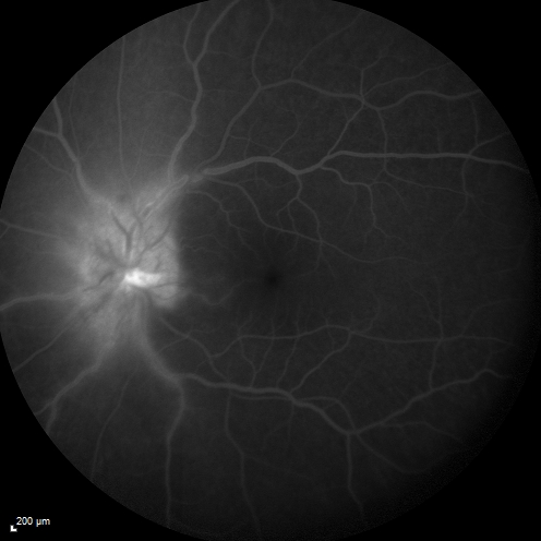 Syphillitic Optic Neuropathy and Maculopathy
46 year old woman with 2 weeks of vision loss OD.  VA 20/200 OD; 20/20 OS.  there are posterior vitreous cells on OCT in both eyes.  ICG, FAF, and FA show an abnormal macula OD.  VA improved to 20/30 within a month with treatment with PCN.
Keywords: syphillis