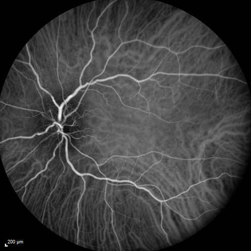 Syphillitic Optic Neuropathy and Maculopathy
46 year old woman with 2 weeks of vision loss OD.  VA 20/200 OD; 20/20 OS.  there are posterior vitreous cells on OCT in both eyes.  ICG, FAF, and FA show an abnormal macula OD.  VA improved to 20/30 within a month with treatment with PCN.
Keywords: syphillis