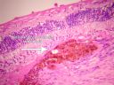 5_AMD_pigmented_scapsr.jpg