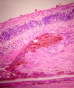 5_AMD_pigmented_scar.JPG
