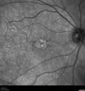 AMD_drusen_fluid1_rosi_112816_05.jpg