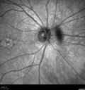 AMD_drusen_fluid1_rosi_112816_06.jpg
