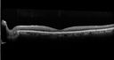 AMD_drusen_fluid1_rosi_112816_14.jpg
