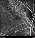 AMD_drusen_fluid1_rosi_112816_23.jpg