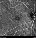 AMD_drusen_fluid1_rosi_112816_24.jpg