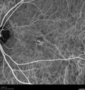 AMD_drusen_fluid1_rosi_112816_29.jpg