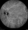 AMD_drusen_fluid1_rosi_112816_30.jpg