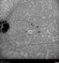 AMD_drusen_fluid1_rosi_112816_32.jpg