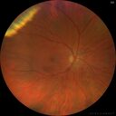 Angioma_litom_051121_01.jpg