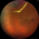 Angioma_litom_051121_02.jpg
