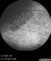 Angioma_litom_051121_05.jpg