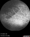 Angioma_litom_051121_06.jpg