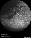 Angioma_litom_051121_07.jpg
