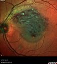 BRVO-hhplaque-avastinfailure_030719_03.jpg