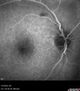 BRVO-hhplaque-avastinfailure_030719_06.jpg