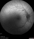 BRVO-hhplaque-avastinfailure_030719_07.jpg