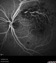 BRVO-hhplaque-avastinfailure_030719_09.jpg