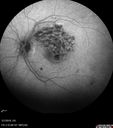 BRVO-hhplaque-avastinfailure_030719_11.jpg