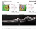BRVO-hhplaque-avastinfailure_030719_12.JPG