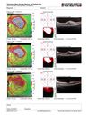 BRVO-hhplaque-avastinfailure_030719_15.JPG