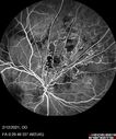 BRVO-venousMA_mebur_022121_11.jpg