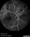 BRVO-venousMA_mebur_022121_12.jpg
