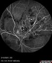 BRVO-venousMA_mebur_022121_13.jpg