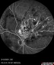 BRVO-venousMA_mebur_022121_15.jpg