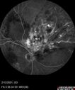 BRVO-venousMA_mebur_022121_18.jpg