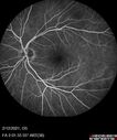 BRVO-venousMA_mebur_022121_19.jpg